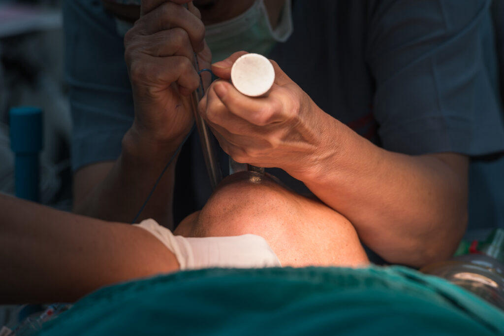 How Anesthesiologists and CRNAs Manage a Difficult Intubation